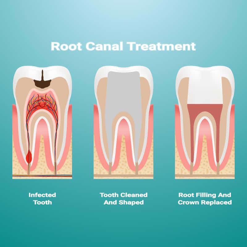 Root Canal Therapy - Drs Linh & Lan Nguyen Kambah Dental ...